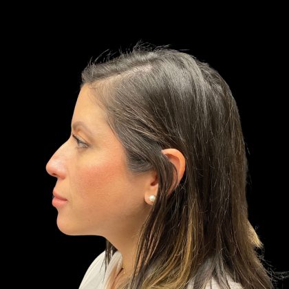 Liquid Rhinoplasty Before & After Patient #10182