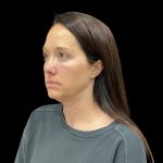 Sculptra Before & After Patient #10184