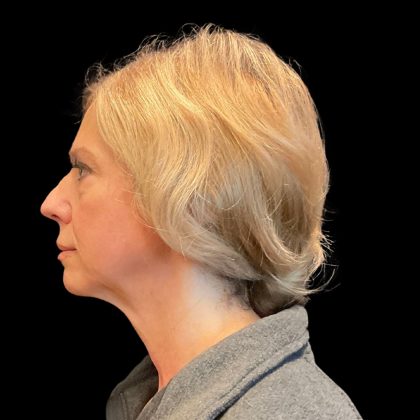 Hyper Dilute Radiesse Before & After Patient #10180
