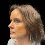 Cheek Filler Before & After Patient #10230