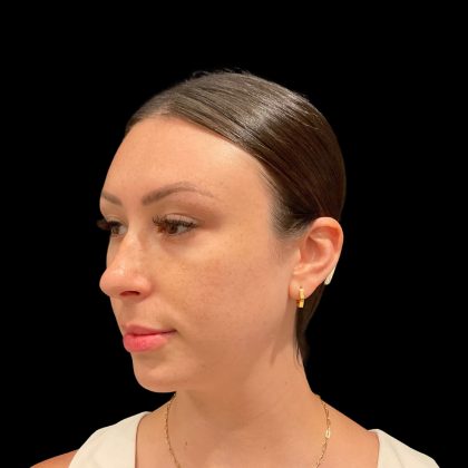 Lumecca Before & After Patient #10181