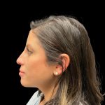 Liquid Rhinoplasty Before & After Patient #10182