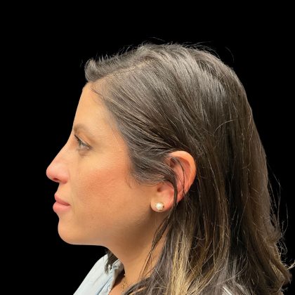 Liquid Rhinoplasty Before & After Patient #10182