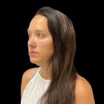 Sculptra Before & After Patient #10184