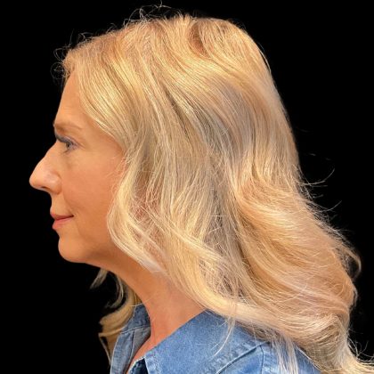 Hyper Dilute Radiesse Before & After Patient #10180