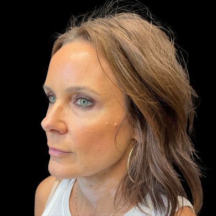 Patient #10230 Cheek Filler Before and After Photos Austin, TX