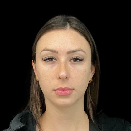 Lumecca Before & After Patient #10181