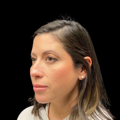 Liquid Rhinoplasty Before & After Patient #10182