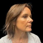 Cheek Filler Before & After Patient #10230