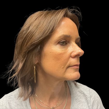 Patient #10230 Cheek Filler Before and After Photos Austin, TX