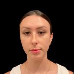 Lumecca Before & After Patient #10181