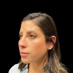 Liquid Rhinoplasty Before & After Patient #10182