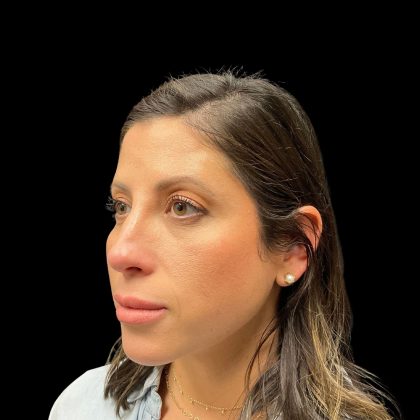 Liquid Rhinoplasty Before & After Patient #10182
