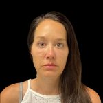 Sculptra Before & After Patient #10184