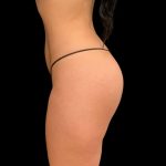 Butt Implants Before & After Patient #10127