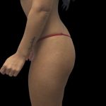 Butt Implants Before & After Patient #10127