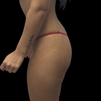 Butt Implants Before & After Patient #10127