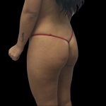 Butt Implants Before & After Patient #10127