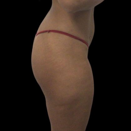 Butt Implants Before & After Patient #10127