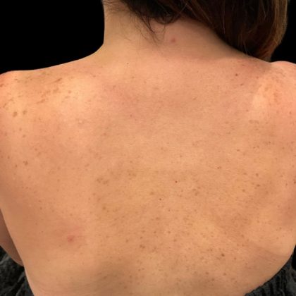 Lumecca Before & After Patient #9737