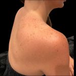 Lumecca Before & After Patient #9737