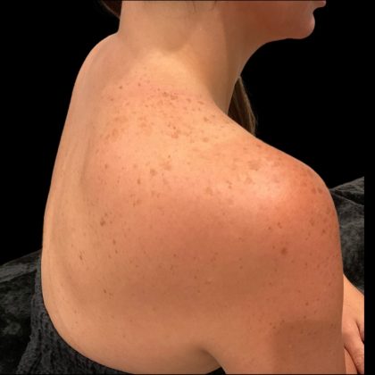 Lumecca Before & After Patient #9737