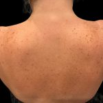 Lumecca Before & After Patient #9737