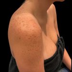 Lumecca Before & After Patient #9737
