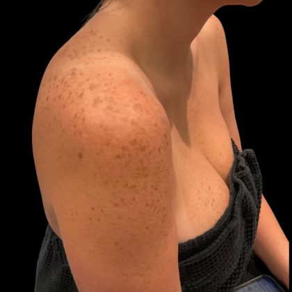 Lumecca Before & After Patient #9737