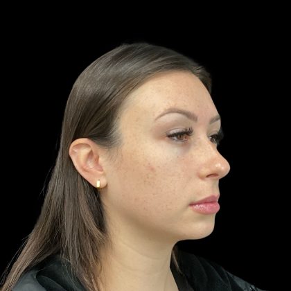 Lumecca Before & After Patient #10181