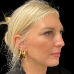 MyEllevate Before & After Patient #9806