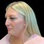 MyEllevate Before & After Patient #9806