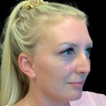 MyEllevate Before & After Patient #9806