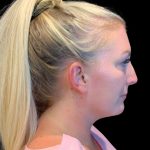 MyEllevate Before & After Patient #9806