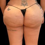 Aveli (Cellulite Removal) Before & After Patient #9755