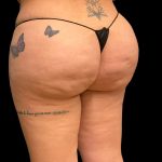 Aveli (Cellulite Removal) Before & After Patient #9755