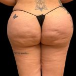 Aveli (Cellulite Removal) Before & After Patient #9755