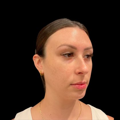 Lumecca Before & After Patient #10181