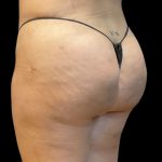Brazilian Butt Lift Before & After Patient #10138
