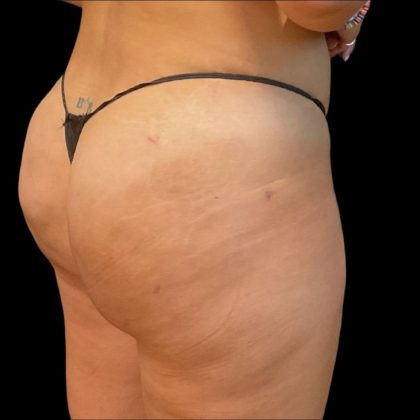 Brazilian Butt Lift Before & After Patient #10138