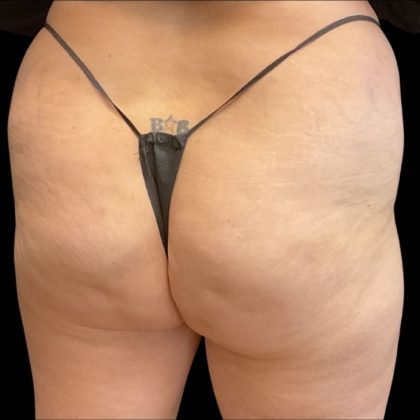 Brazilian Butt Lift Before & After Patient #10138