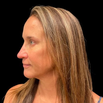 Morpheus8 Before & After Patient #9936