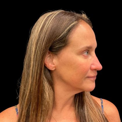 Morpheus8 Before & After Patient #9936