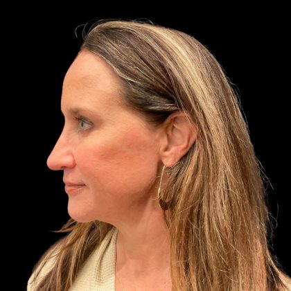 Morpheus8 Before & After Patient #9936