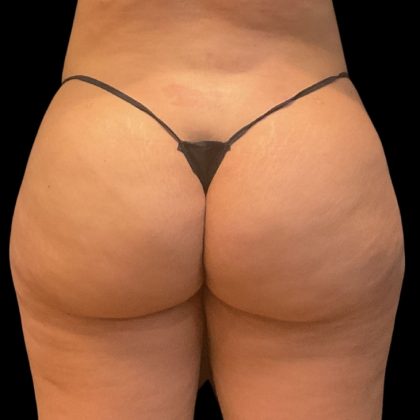 Aveli (Cellulite Removal) Before & After Patient #9770