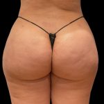 Aveli (Cellulite Removal) Before & After Patient #9770
