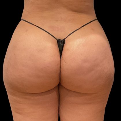 Aveli (Cellulite Removal) Before & After Patient #9770