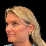 Facelift Before & After Patient #9828