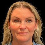Facelift Before & After Patient #9828