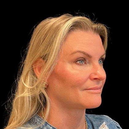 Facelift Before & After Patient #9828